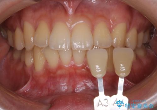 クリスマスにホワイトニングで白くしたいの治療前