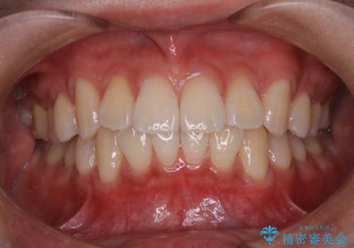 クリスマスにホワイトニングで白くしたいの治療後