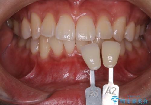 クリスマスにホワイトニングで白くしたいの治療後