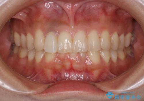 前歯1本をセラミック(被せ物)にする前に、全体的に白くしていくオフィスホワイトニングの治療前