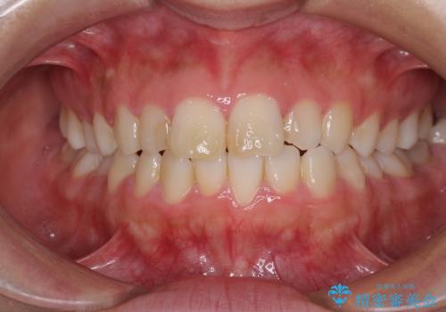 気になる前歯を治したい インビザラインで気づかれずに矯正治療の症例 治療前