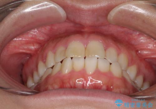 気になる前歯を治したい インビザラインで気づかれずに矯正治療の治療前