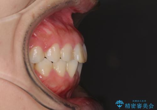 気になる前歯を治したい インビザラインで気づかれずに矯正治療の治療前