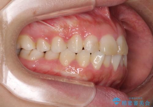 気になる前歯を治したい インビザラインで気づかれずに矯正治療の治療前