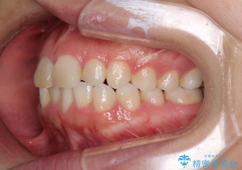 気になる前歯を治したい インビザラインで気づかれずに矯正治療の治療前