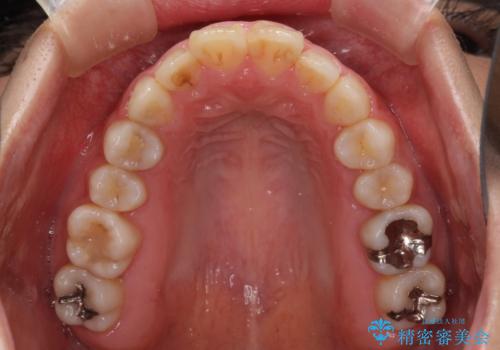 気になる前歯を治したい インビザラインで気づかれずに矯正治療の治療前