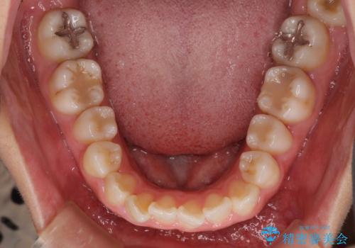 気になる前歯を治したい インビザラインで気づかれずに矯正治療の治療前