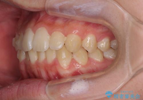 しっかり使って短期間で治療 インビザラインによる叢生解消の治療中