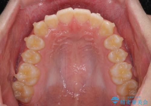 しっかり使って短期間で治療 インビザラインによる叢生解消の治療中