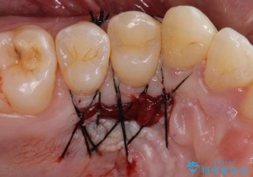 ほぼ歯根全てが露出　2度の歯肉移植術で自然な見た目にの治療前
