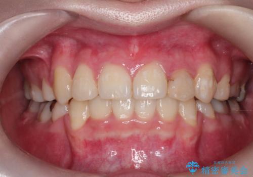 八重歯が気になる　ワイヤーによる抜歯矯正できれいな歯並びへの症例 治療後
