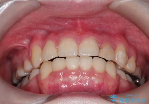 八重歯が気になる　ワイヤーによる抜歯矯正できれいな歯並びへの治療後