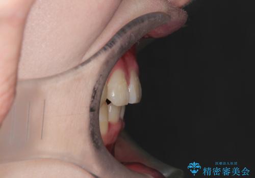 八重歯が気になる ワイヤーによる抜歯矯正できれいな歯並びへの治療後