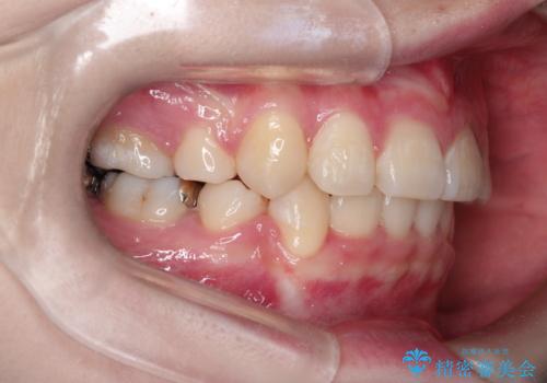 八重歯が気になる ワイヤーによる抜歯矯正できれいな歯並びへの治療後