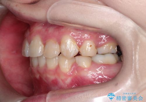 八重歯が気になる ワイヤーによる抜歯矯正できれいな歯並びへの治療後