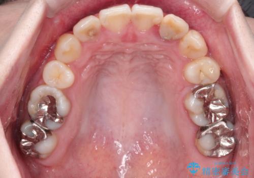 八重歯が気になる ワイヤーによる抜歯矯正できれいな歯並びへの治療後