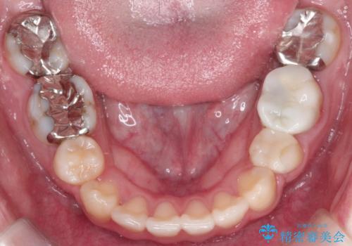 八重歯が気になる ワイヤーによる抜歯矯正できれいな歯並びへの治療後