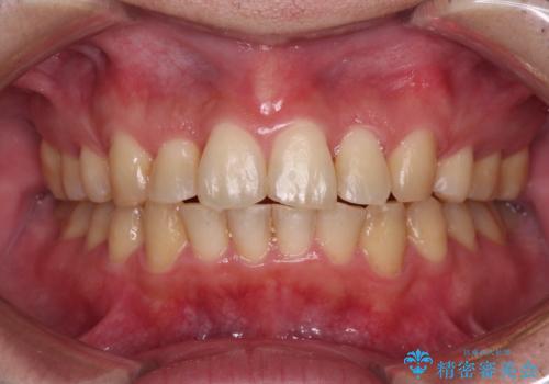 強い咬み込みですり減った前歯　デコボコを抜歯矯正で整えるの症例 治療後