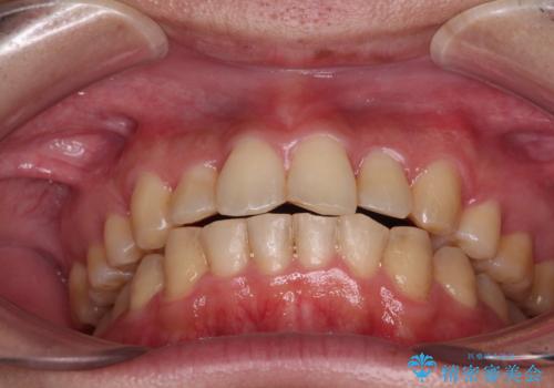 強い咬み込みですり減った前歯 デコボコを抜歯矯正で整えるの治療後