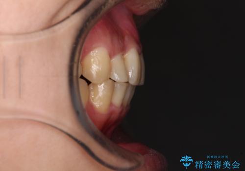 強い咬み込みですり減った前歯 デコボコを抜歯矯正で整えるの治療後