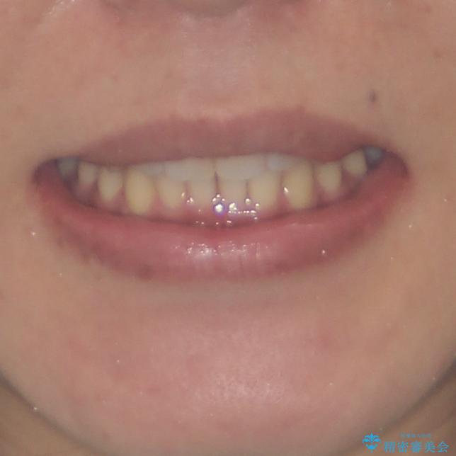 沖縄から飛行機で通院 インビザラインによる矯正治療の治療後(顔貌)