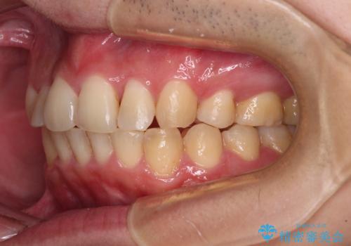 強い咬み込みですり減った前歯 デコボコを抜歯矯正で整えるの治療後