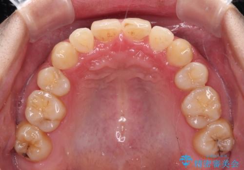 強い咬み込みですり減った前歯 デコボコを抜歯矯正で整えるの治療後