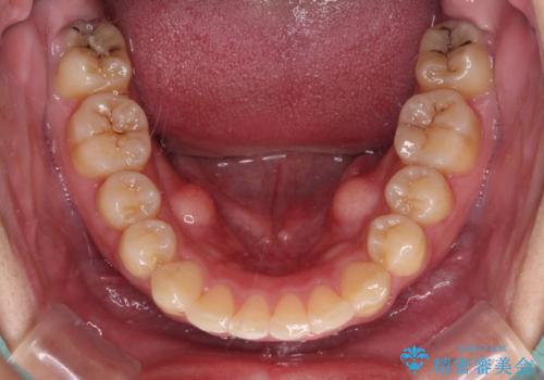 強い咬み込みですり減った前歯 デコボコを抜歯矯正で整えるの治療後