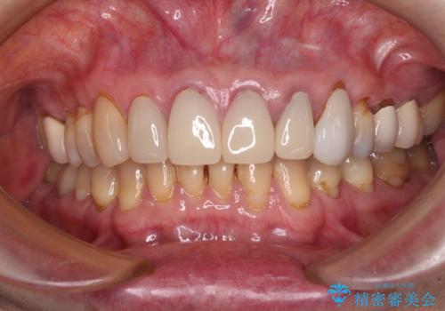 もげてしまった前歯をセラミッククラウンで自然にの治療前