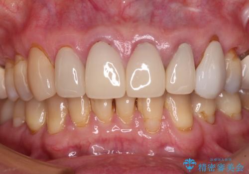 もげてしまった前歯をセラミッククラウンで自然にの治療前