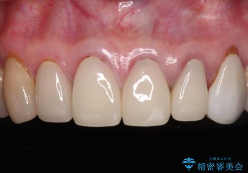 もげてしまった前歯をセラミッククラウンで自然にの症例 治療前