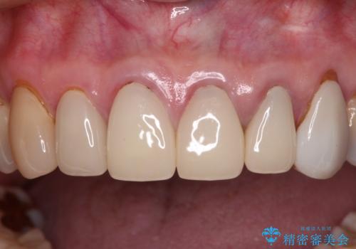 もげてしまった前歯をセラミッククラウンで自然にの治療前