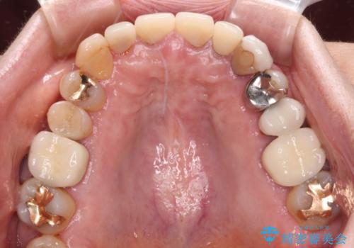 もげてしまった前歯をセラミッククラウンで自然にの治療前