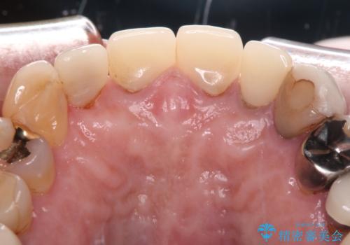 もげてしまった前歯をセラミッククラウンで自然にの治療前