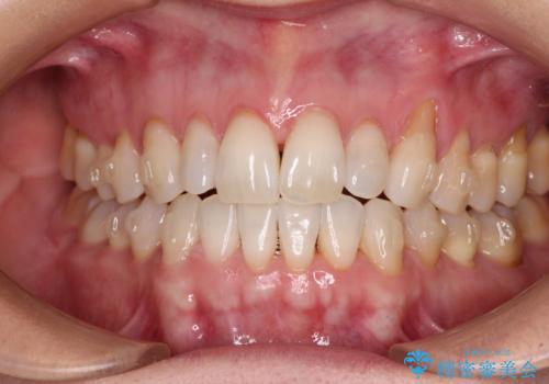 前歯のスペースが気になる インビザラインによる矯正治療の治療中