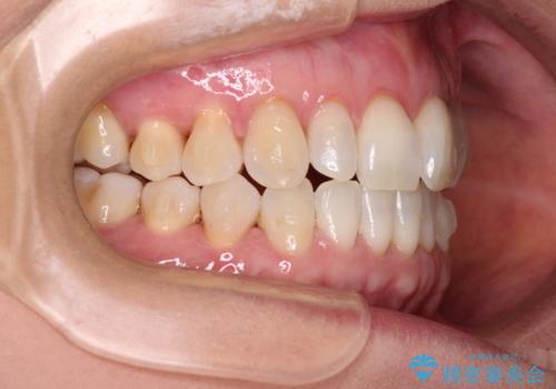 前歯のスペースが気になる インビザラインによる矯正治療の治療中