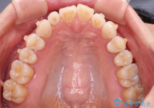 前歯のスペースが気になる　インビザラインによる矯正治療の治療中