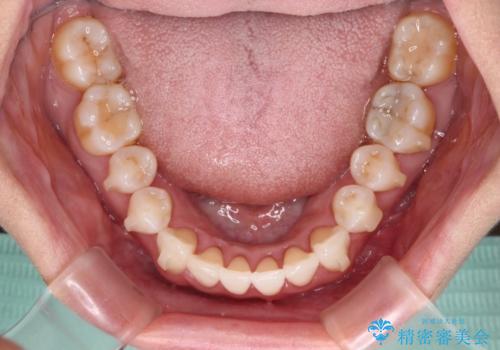 前歯のスペースが気になる インビザラインによる矯正治療の治療中