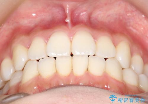 軽度の前歯のガタガタをインビザラインでの目立たない矯正の治療後