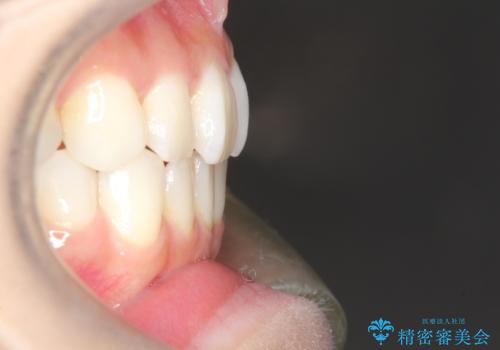 軽度の前歯のガタガタをインビザラインでの目立たない矯正の治療後