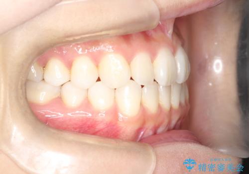 軽度の前歯のガタガタをインビザラインでの目立たない矯正の治療後