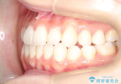 軽度の前歯のガタガタをインビザラインでの目立たない矯正の治療後