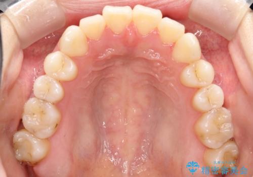 軽度の前歯のガタガタをインビザラインでの目立たない矯正の治療後