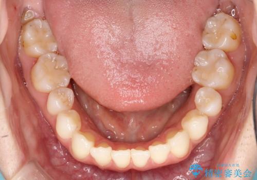 軽度の前歯のガタガタをインビザラインでの目立たない矯正の治療後