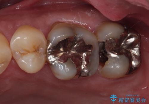 歯に穴が空いてしみる　ものが挟まってしまうほど大きな奥歯のむし歯の症例 治療前