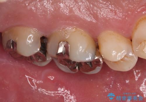 歯に穴が空いてしみる ものが挟まってしまうほど大きな奥歯のむし歯の治療前