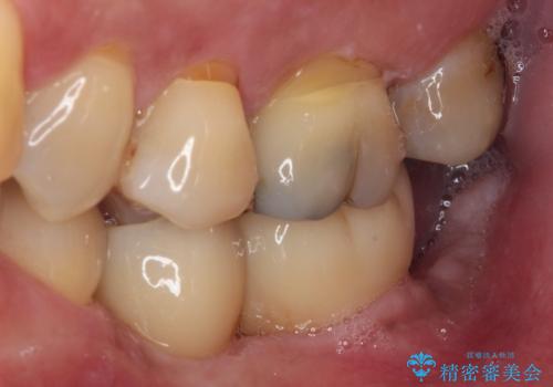 歯に穴が空いてしみる ものが挟まってしまうほど大きな奥歯のむし歯の治療前