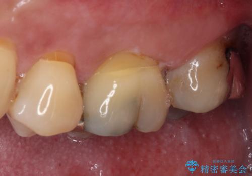 歯に穴が空いてしみる　ものが挟まってしまうほど大きな奥歯のむし歯の治療前