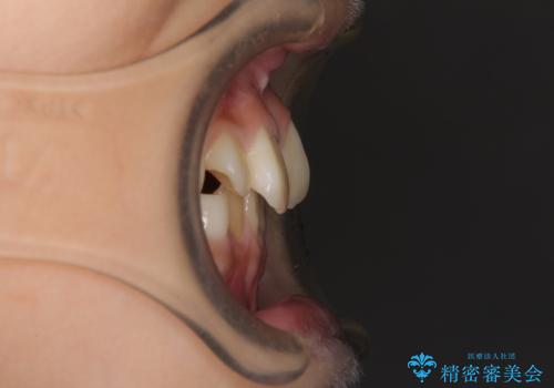 過剰歯を抜歯して前歯を排列 インビザライン・ファーストによる小学生のⅠ期治療の治療前