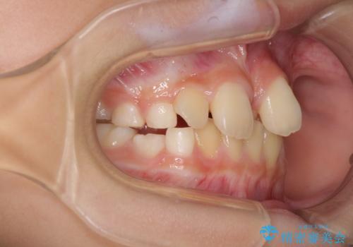 過剰歯を抜歯して前歯を排列 インビザライン・ファーストによる小学生のⅠ期治療の治療前